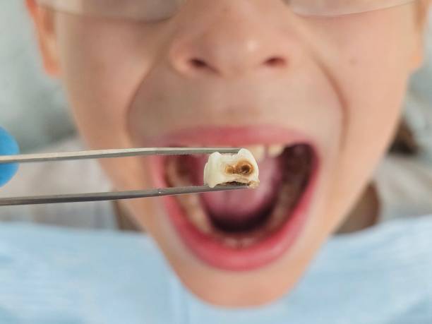 Best Emergency Tooth Extraction in Santee, SC